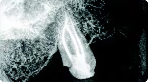 Close up of sealed tooth