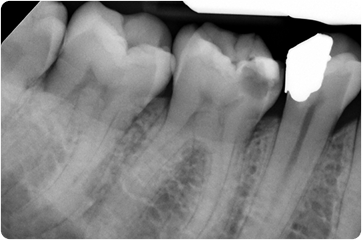 Xray of tooth before root canal