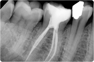 XRay of sealed tooth