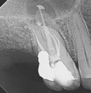 gutta percha case study