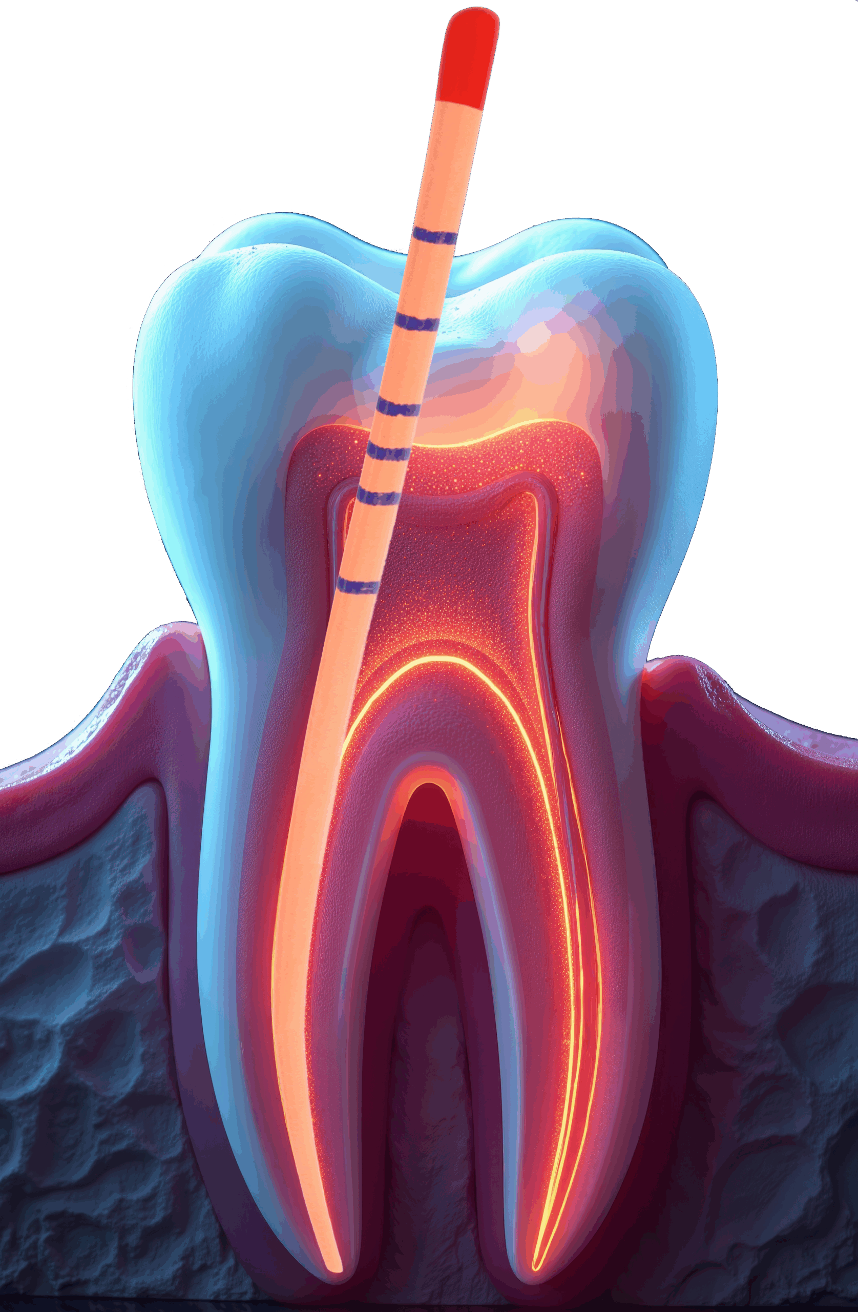 gp inside tooth